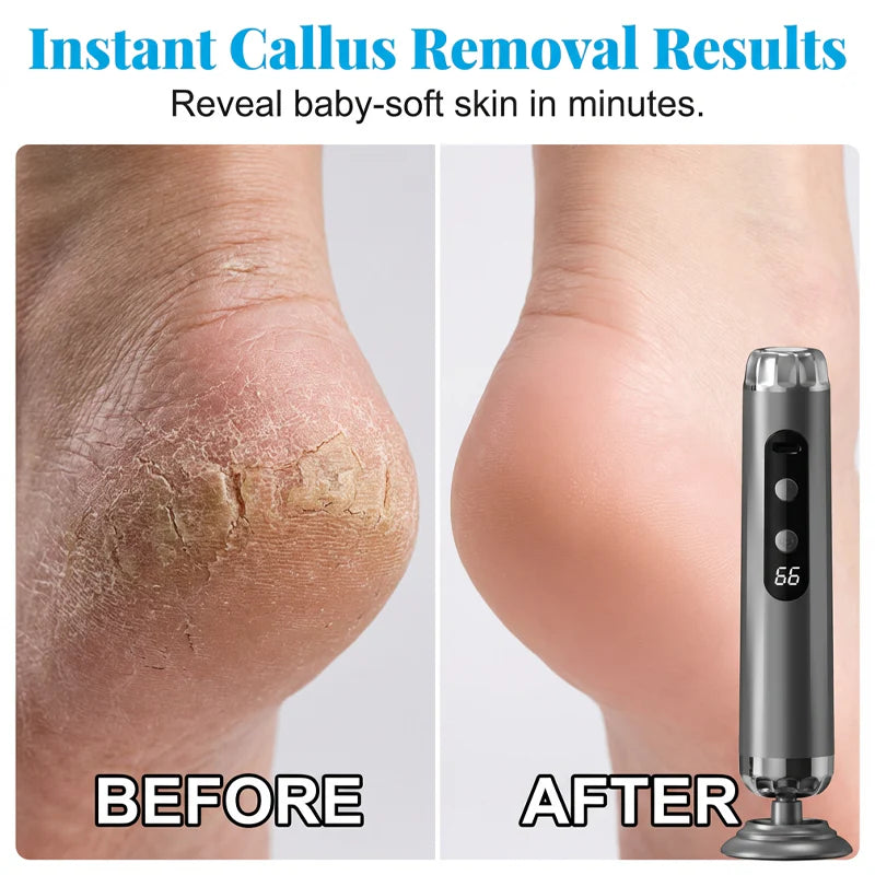 🔥Limited Time 50% Off⏰Multi-Function Electric Foot Grinder with 5 Speeds